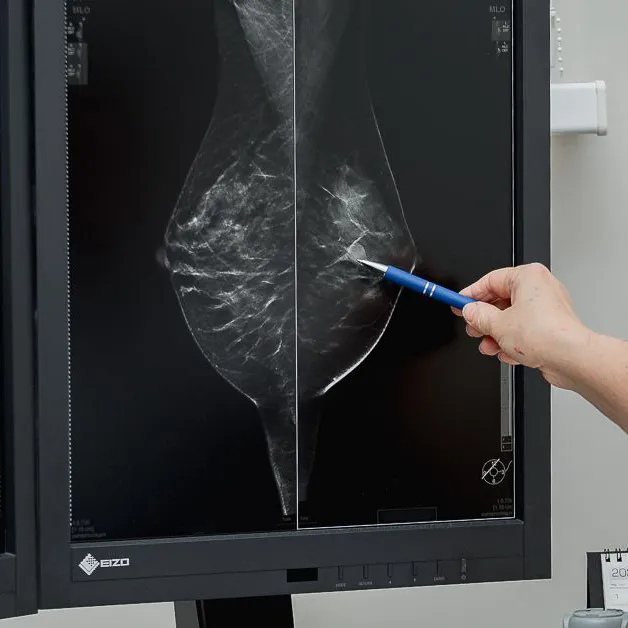 Mammography: why is it necessary after 50 and how does it differ from breast ultrasound?