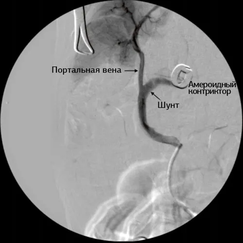 Arteriography
